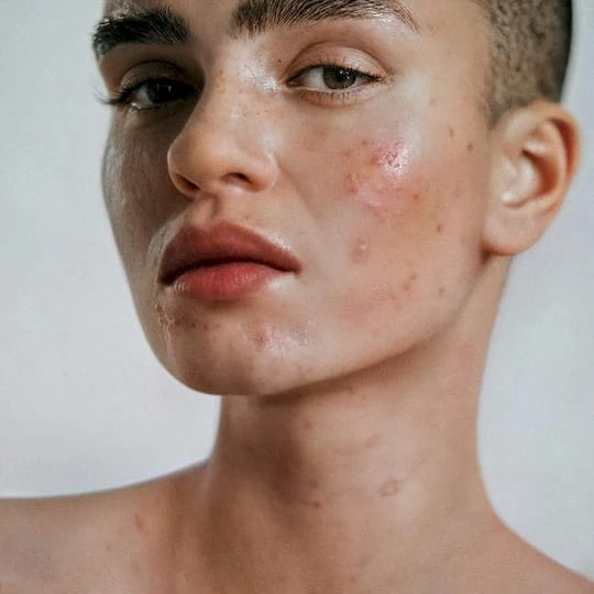 Treat acne with expert guidance: step-by-step solutions